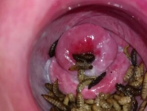 CERVIX MAGGOTS